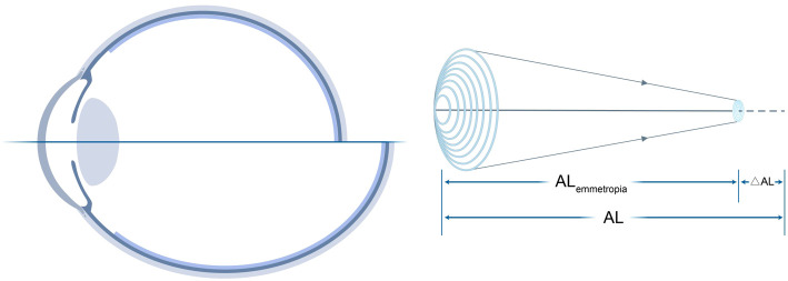 Myopic Strain: a normalized metric concept for assessing axial myopia.