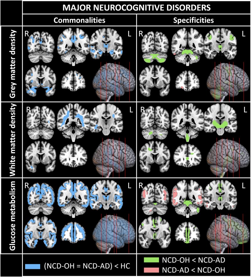 Cognitive and cerebral phenotypes of neurocognitive disorders due to alcohol or Alzheimer's disease.