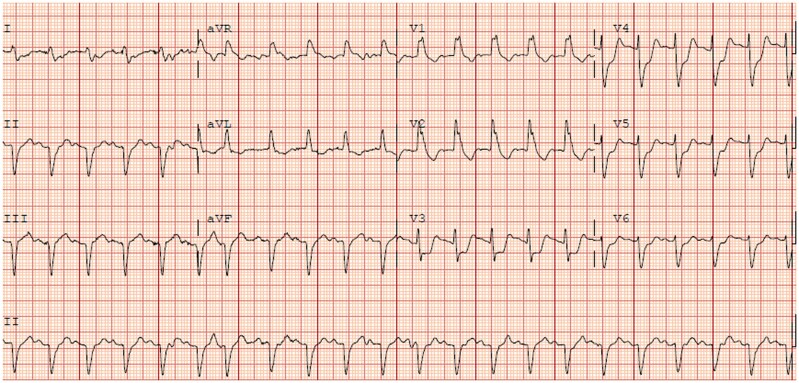 A case report of fulminant eosinophilic myo-pericarditis related to checkpoint inhibitors complicated by acute heart failure and cardiac tamponade.