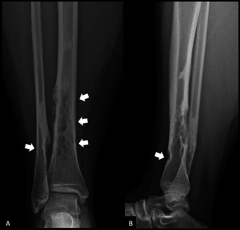 Osteofibrous Dysplasia Involving Both Tibia and Fibula: A Rare Campanacci‑Type Presentation.