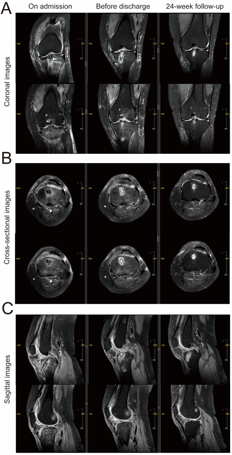 A Case Report of Refractory <i>Mycobacterium wolinskyi</i> Knee Infection in a Metabolic Syndrome Patient: mNGS Diagnosis and Pharmacist-Guided Therapy.