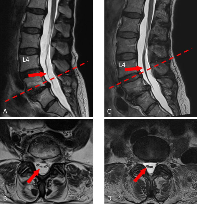 Conus medullaris and cauda equina syndrome as complications of non-imaging guided epidural steroid injection: two case reports with comprehensive interdisciplinary work-up.