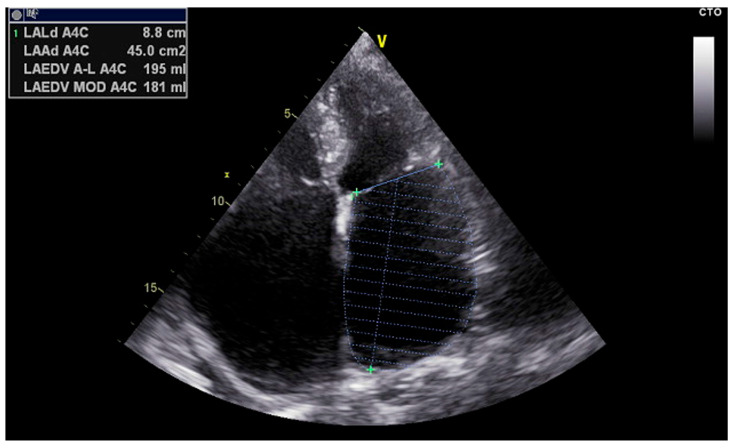 Left Atrial Mechanics and Remodeling in Paroxysmal Atrial Fibrillation: Introducing the EASE Score for Pre-Ablation Risk Prediction.