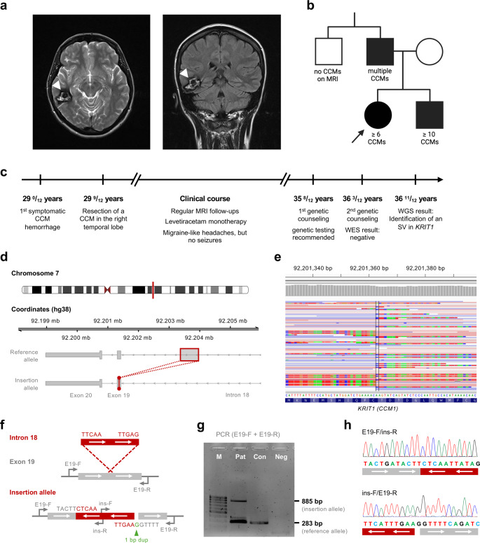 Familial cerebral cavernous malformations caused by a novel germline structural variant in the KRIT1 gene.