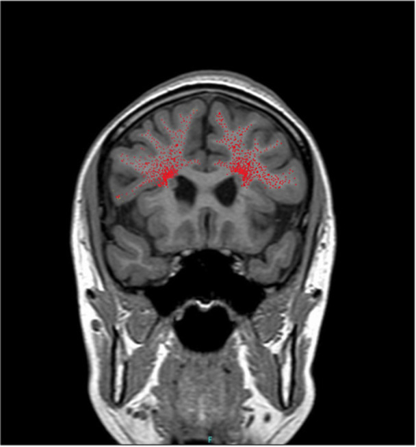 Successful use of clozapine in a patient with schizophrenia comorbid with 22q11.2 deletion syndrome and multiple periventricular nodular heterotopia: A case report.