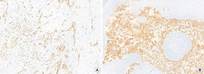 Sarcomatoid squamous cell carcinoma arising in a post-acupuncture keloid scar: a case report and literature review.