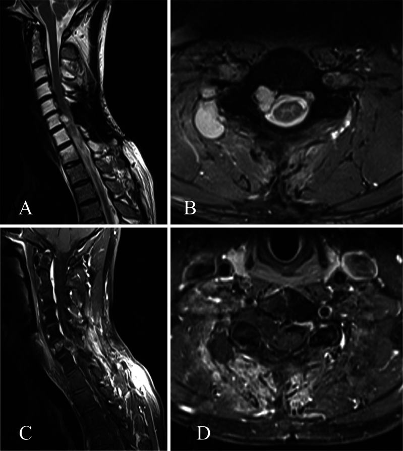 Long-term follow-up after cervical en bloc resection as salvage surgery of spinal chondrosarcoma: illustrative case.