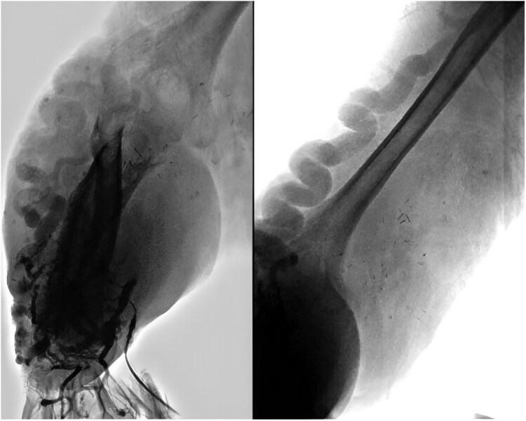 Parkes Weber syndrome, a rare case of pulmonary hypertension: a case report.