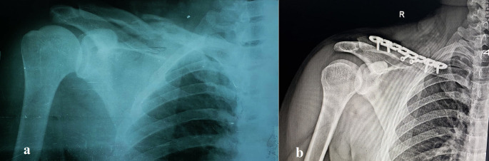 Functional Outcomes of Displaced Midshaft Clavicular Fractures Treated with Precontoured Locked Plates: A Prospective Study.