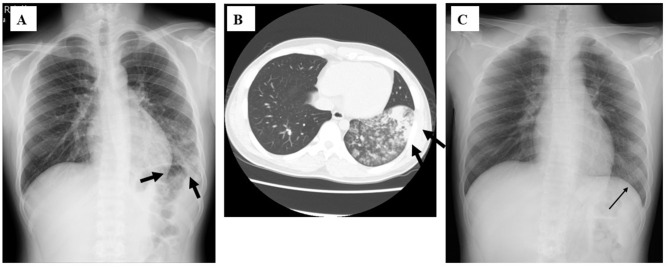 Adult Hospitalized Mycoplasma Cases in a Tertiary Hospital in Japan.