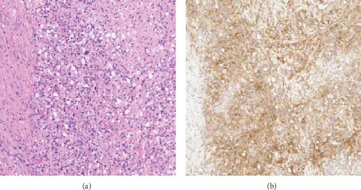 Simultaneous Lymphoepithelioma-Like and Plasmacytoid Subtypes of Urothelial Carcinoma, Along With Prostatic Adenocarcinoma With Clinical Follow-Up.
