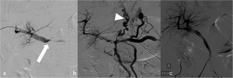 Portal vein stent to save the day.