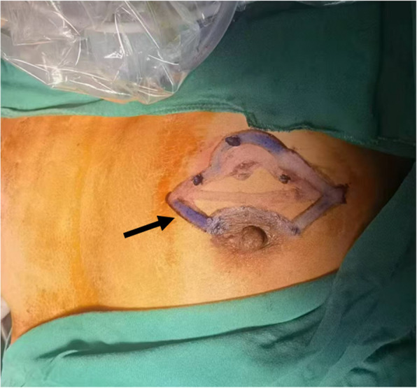 Assessment of surgical precision and safety in oncoplastic breast-conserving surgery for breast cancer under the guidance of imaging.