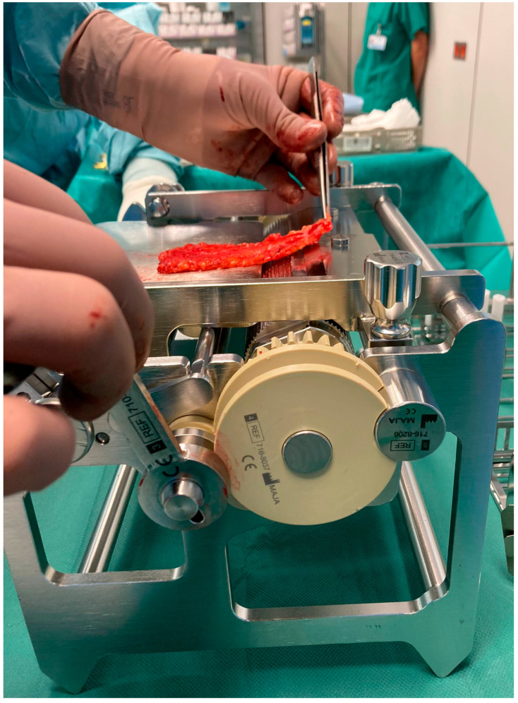 Development of a Device for Defatting Full Skin Grafts Through Mechanical Defatting in Children and Adolescents.