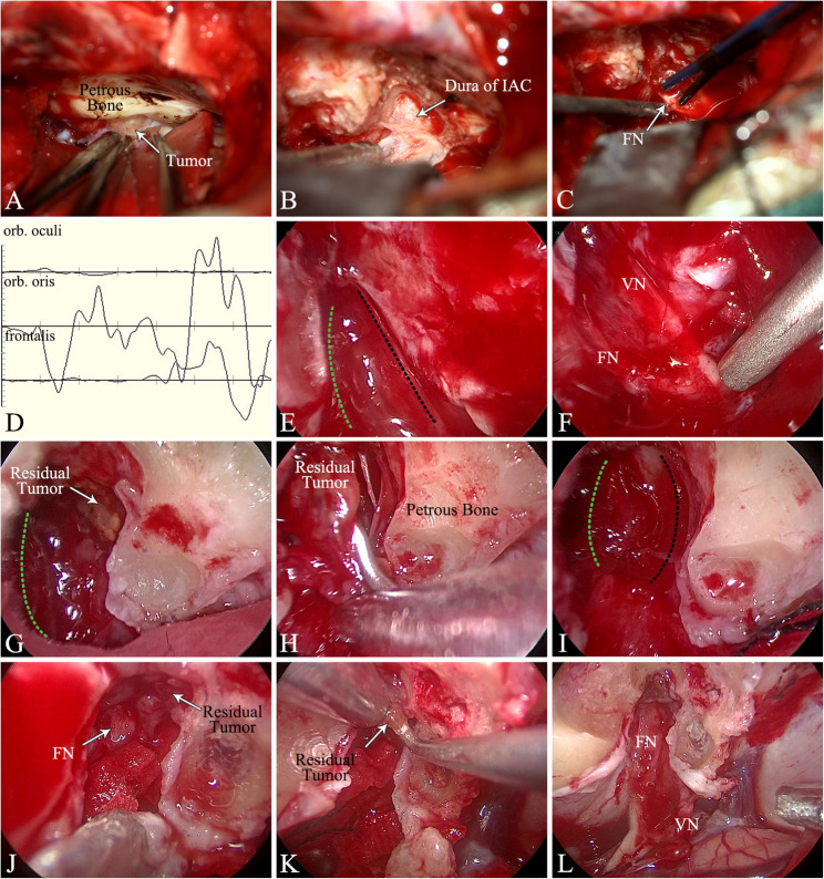 Treatment of small vestibular schwannomas using microscopic with endoscopic surgery: a single-center retrospective analysis.