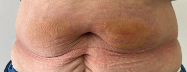 When Skin Reactions Interrupt Bone Therapy: Severe Cutaneous Adverse Reaction to Romosozumab Leading to Treatment Discontinuation.
