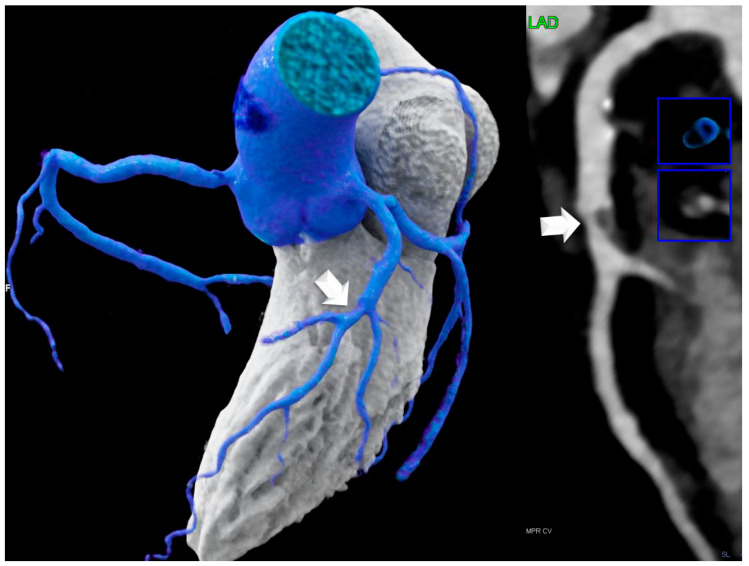 Lipomatous Hypertrophy of the Interatrial Septum (LHIS) a Biomarker for Cardiovascular Protection? A Hypothesis Generating Case-Control Study.