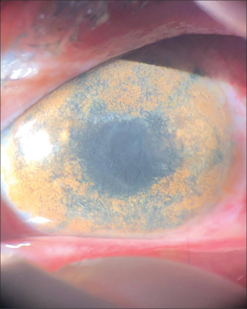 Keratopigmentation in the modern era: A review of current techniques, results, and safety.