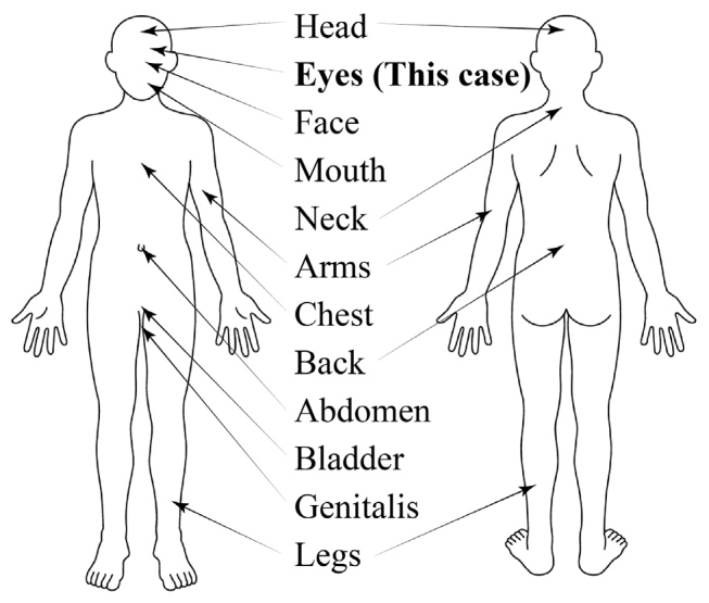 Restless Eyes at Night: A Novel Variant of Restless Legs Syndrome.