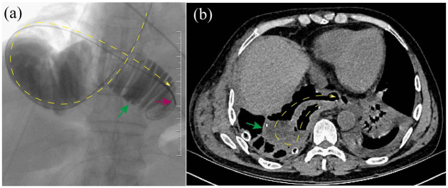 Rare complications after esophagectomy: incidence, clinical features, risk factors, management, and prevention.