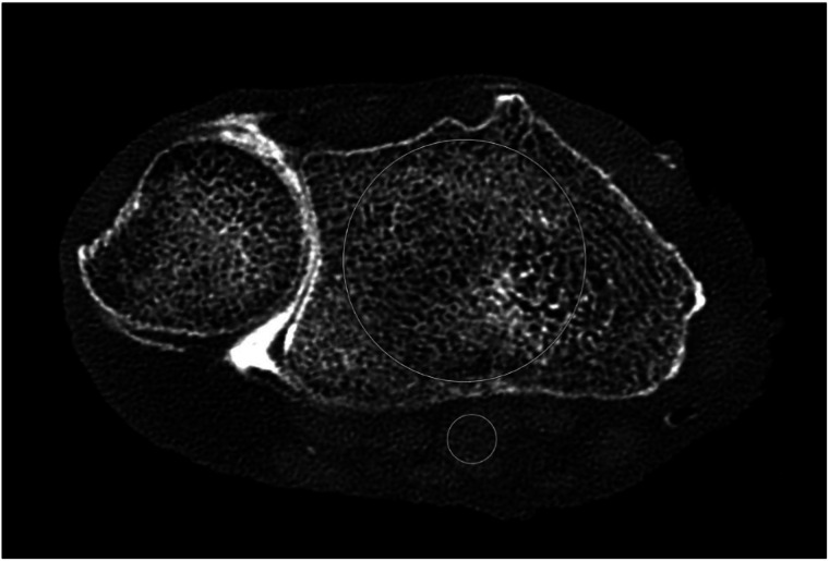 Photon-counting CT versus energy-integrating detector and flat-panel CT for cadaveric wrist arthrography with additional tin filter dose reduction.
