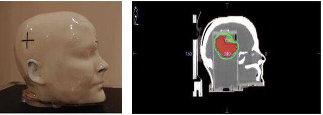 Effectiveness of EPID-based in-vivo dosimetry with EPIgray<sup>®</sup> Software for head and neck VMAT treatments.