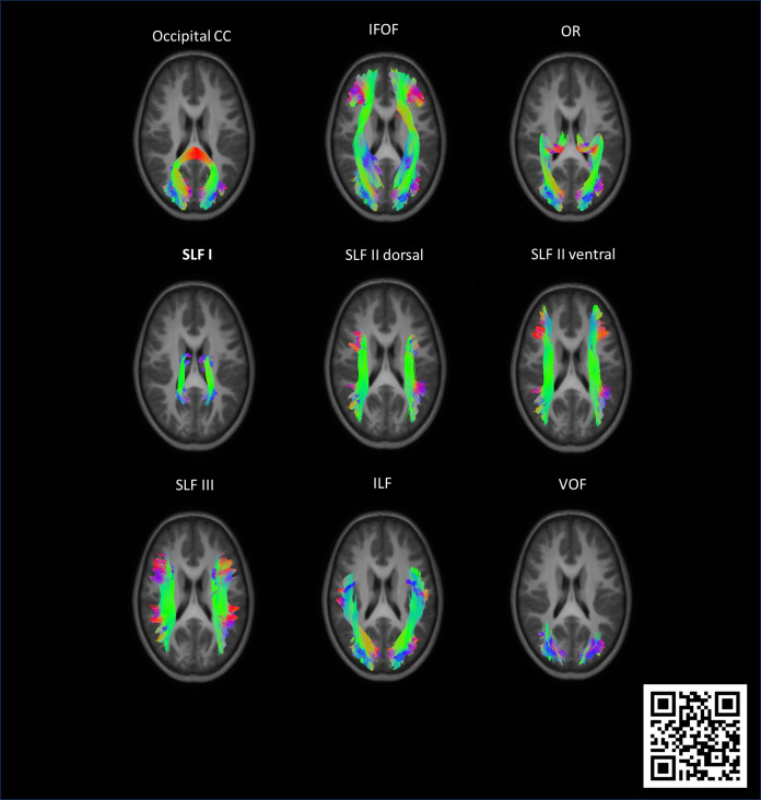 Neural micro and macrostructural correlates of visual outcomes in children with unilateral cerebral palsy: A fixel-based study.