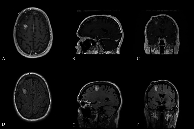 High-grade glioma with pleomorphic and pseudopapillary features: a single-institution series of three cases.