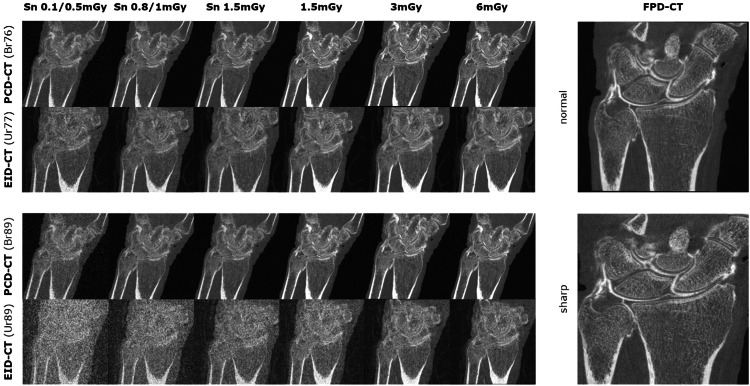 Photon-counting CT versus energy-integrating detector and flat-panel CT for cadaveric wrist arthrography with additional tin filter dose reduction.