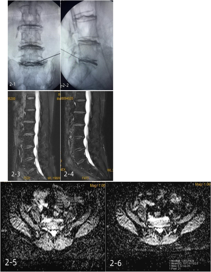 Platelet-rich plasma for the treatment of discogenic low back pain: a prospective randomized controlled trial.