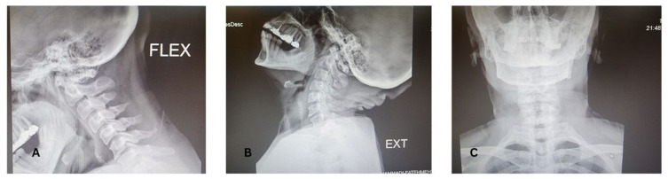 Septic Shock After Surgery in Arnold-Chiari Malformation Type I: A Case Report.