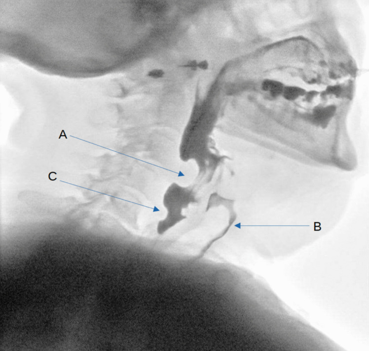 Dysphagia from an aberrant internal carotid artery: a case report.