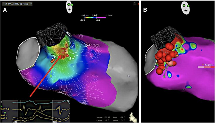 Ablation of ventricular tachycardia originating from the lower and septal portion of aortic prosthesis following transcatheter aortic valve replacement: a case report.