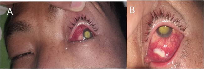 Seasonal Hyperacute Panuveitis from the highest reported altitude: co-occurrence with scleritis - an unusual presentation.