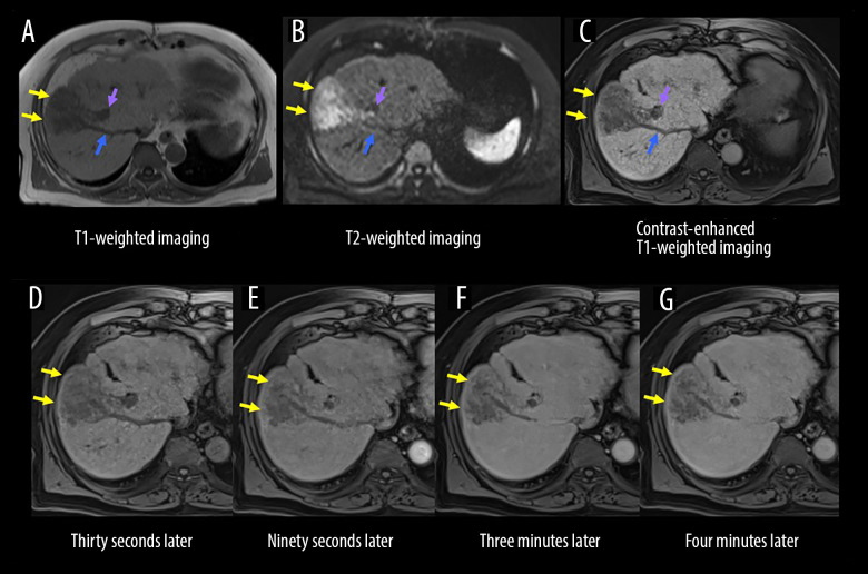 Rapid Progression of Primary Hepatic Neuroendocrine Carcinoma: A Case Report Demonstrating Drastic Oncological Behavior.
