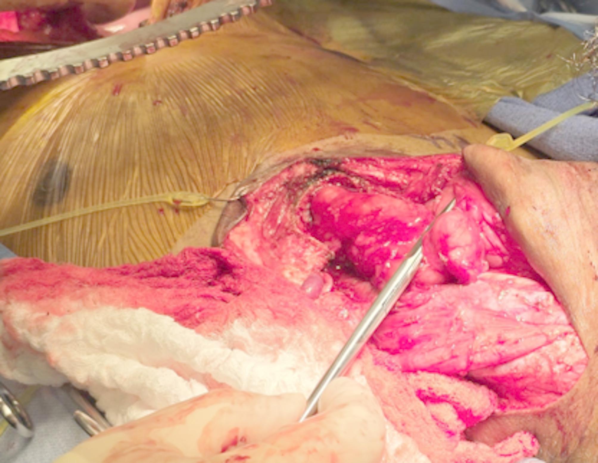 Esophageal reconstruction using a hypopharyngeal anastomosis - a single center experience with review of the literature.
