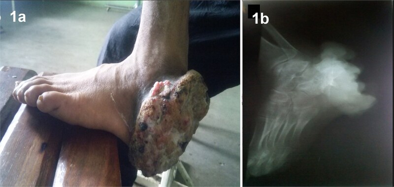 A case of chromoblastomycosis with osteolytic lesions of the foot.
