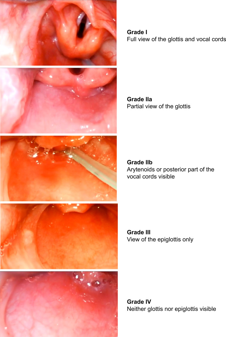 Video analysis of neonatal intubations using video laryngoscopy: a prospective comparison of clinical practice with resuscitation guidelines.