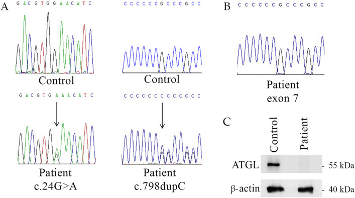 Case Report: Pathogenic <i>PNPLA2</i> variants and nonsense-mediated mRNA decay result in an early-onset neutral lipid storage disease with myopathy.