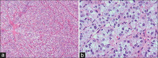 Metastasis of follicular carcinoma of the thyroid gland to the mandible: A report of a rare case.