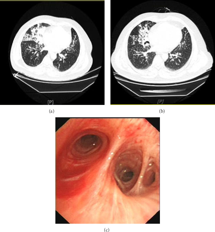 Bronchoalveolar Lavages Combined With Glucocorticoids in Management of Acute Exogenous Lipoid Pneumonia: 3 Case Reports.