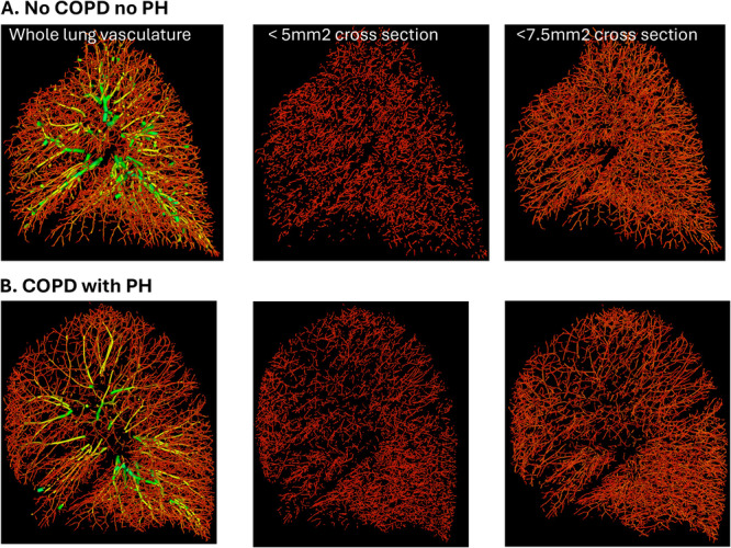 Significance of Pulmonary Vascular Dysfunction in Chronic Obstructive Pulmonary Disease.