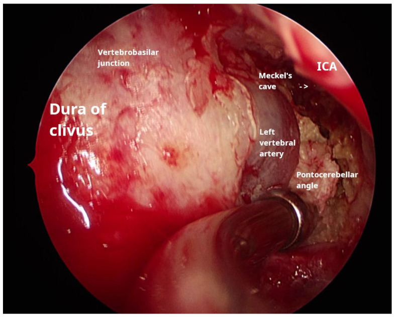 Extensive Cholesteatoma Compromising the Entire Ipsilateral Skull Base: Excision Through a Multi-Corridor Surgical Technique.