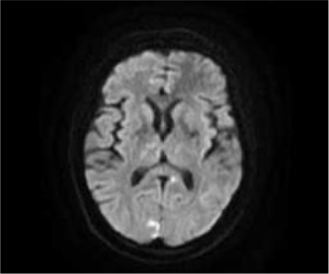 Rapidly Progressive Primary Central Nervous System Vasculitis: A Rare Case with Multifocal Small and Medium Vessel Involvement.