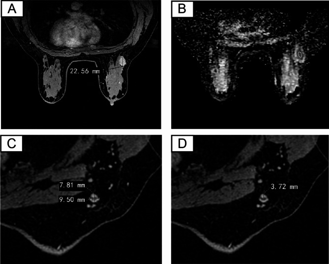 A non-invasive preoperative model for predicting sentinel lymph node metastasis in breast cancer using clinical data and MRI.
