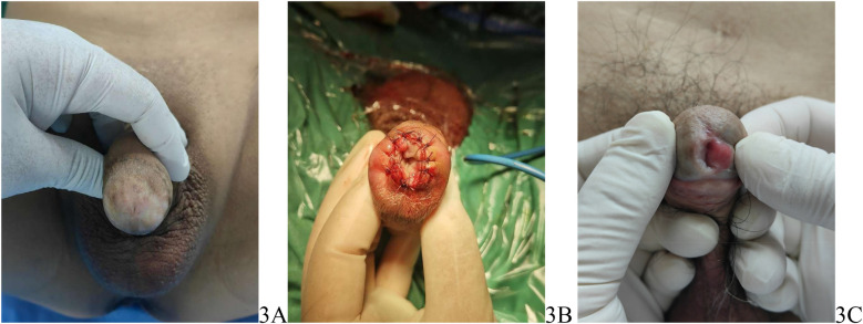 Clinical observation of transurethral reconstruction of urethral meatus and navicularis fossa short strictures with annular inlay oral mucosa graft urethroplasty.