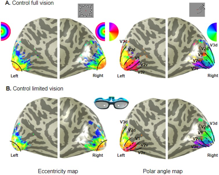 Cortical response to transient and long-term visual field loss.