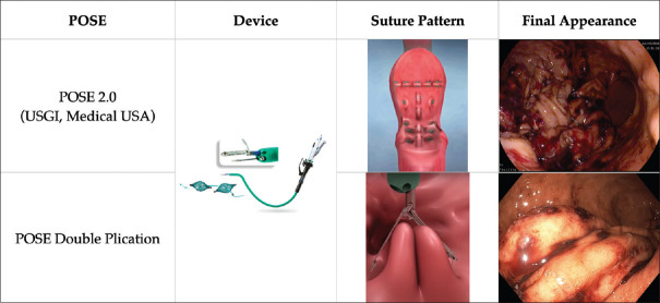 Recent advances in bariatric endoscopy for obesity management: expanding the therapeutic spectrum.