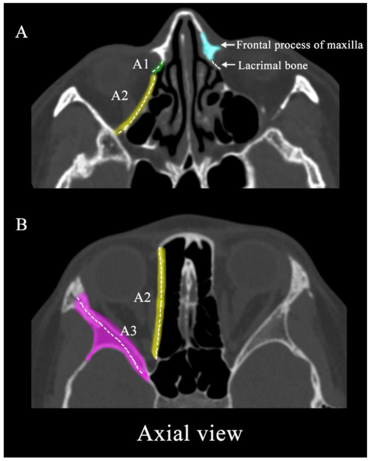 Predictors of diplopia following orbital fractures based on anatomical location, a retrospective cohort study.