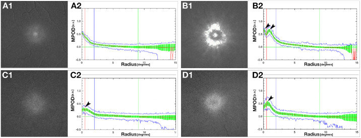 Advanced Analysis Tools for Two Wavelength Autofluorescence Imaging of Macular Xanthophyll Carotenoids: ALSTAR2 Baseline.